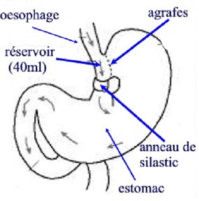 gastroplastie