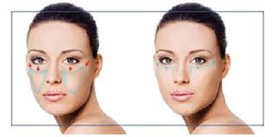 Lifting endoscopique : Rajeunissement du visage peu invasif