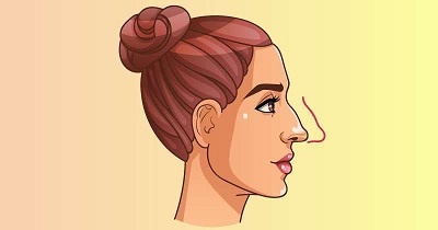 Rhinoplastie nez crochu : Ce qu’il faut savoir