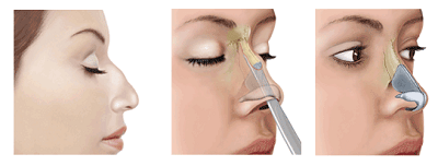 rhinoplastie pointe du nez