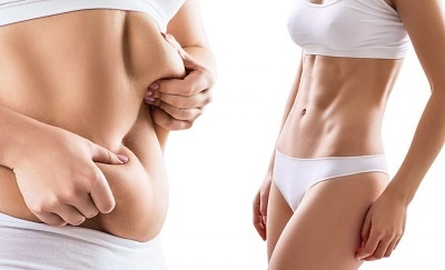 liposuccion 10 litres avis