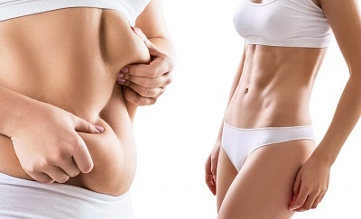 Liposuccion 10 litres : Est-ce possible et comment se fait-elle ?