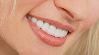 facettes dentaires abiment-elles les dents