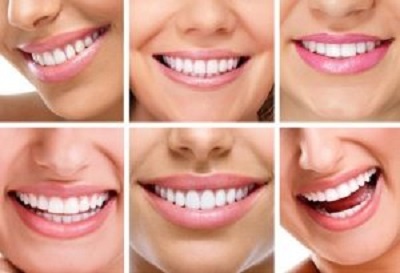 les facettes dentaires abiment-elles les dents