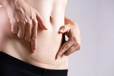 Peut on faire une abdominoplastie après une césarienne ?