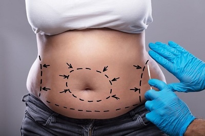 quel examen avant une abdominoplastie