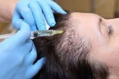 mesogreffe cheveux traitement capillaire cellules souches