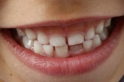 facettes dentaires et sensibilite des dents
