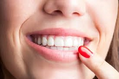 gingivectomie en tunisie