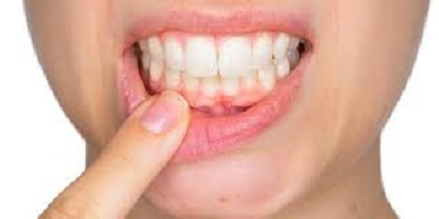 gingivectomie tunisie