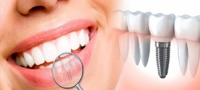 implants dentaires turquie