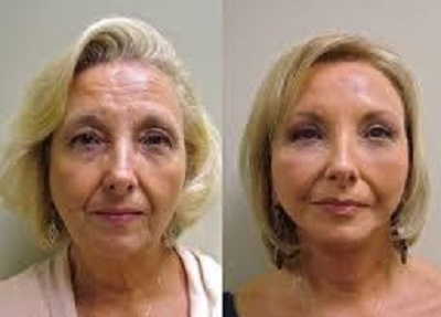 Lifting frontal Tunisie