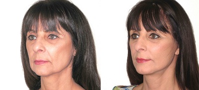 lifting visage en tunisie