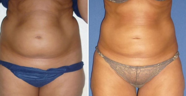 liposuccion ventre