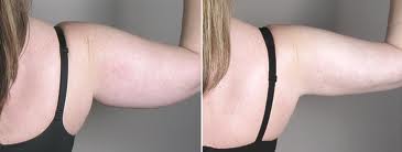 liposuccion des bras