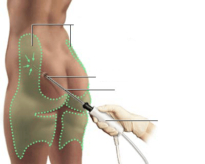 Liposuccion laser Tunisie