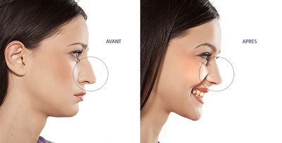 Prix d'une rhinoplastie en france