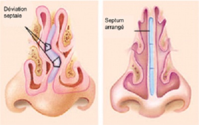 prix septoplastie tunisie