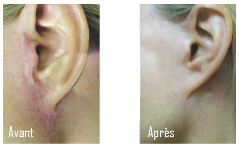 Traitement cicatrices au laser